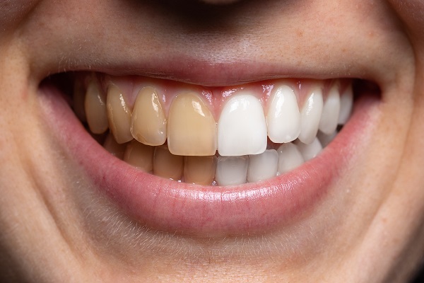 How Can Cosmetic Dentistry Improve Stained Teeth?