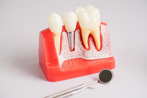 Are Dental Implants Permanent Restorations?