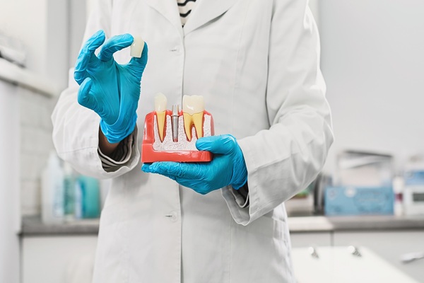 A Guide To Partial And Full Arch Dental Implants