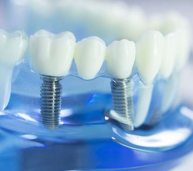 La Puente Dental Implants
