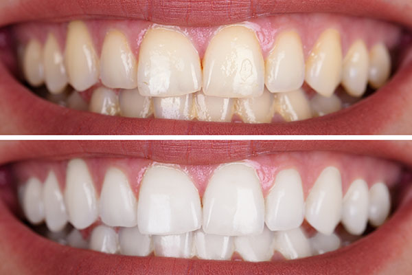 How Long Do The Results Of Teeth Whitening Treatments Last