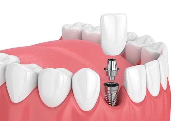 How Painful is Dental Implant Surgery from MyDentist La Puente in La Puente, CA