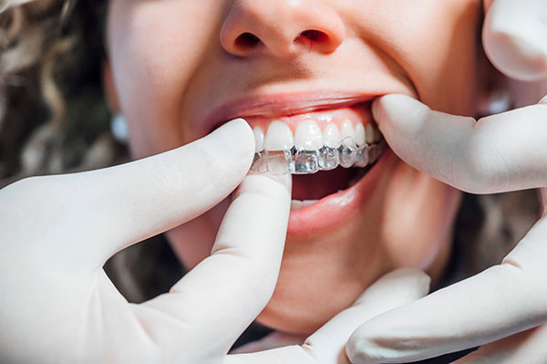 Invisalign Is Effective For Less Complex Orthodontic Cases