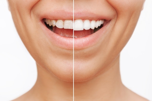 Ways A Smile Makeover Can Improve Your Smile