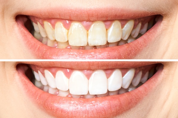 Comparing Take Home Trays Vs  In Office Teeth Whitening