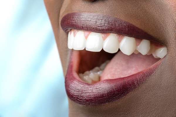 Routine Dental Care: What Are Tooth Colored Fillings from MyDentist La Puente in La Puente, CA